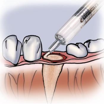 Preview: VORTEILSANGEBOT: CERASORB Paste 5 x 0,5cc